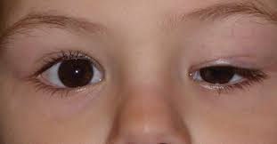 ptosis niño
